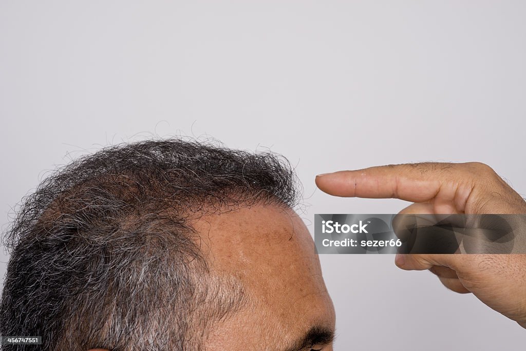 Six months after hair transplant surgery six months after hair transplant surgery Hair Transplant Stock Photo