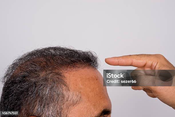 Six Months After Hair Transplant Surgery Stock Photo - Download Image Now - Hair Transplant, Adult, Adults Only