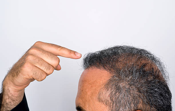 istock Six months after hair transplant surgery 456799281