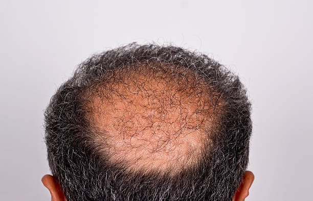 istock Six months after hair transplant surgery 457235903