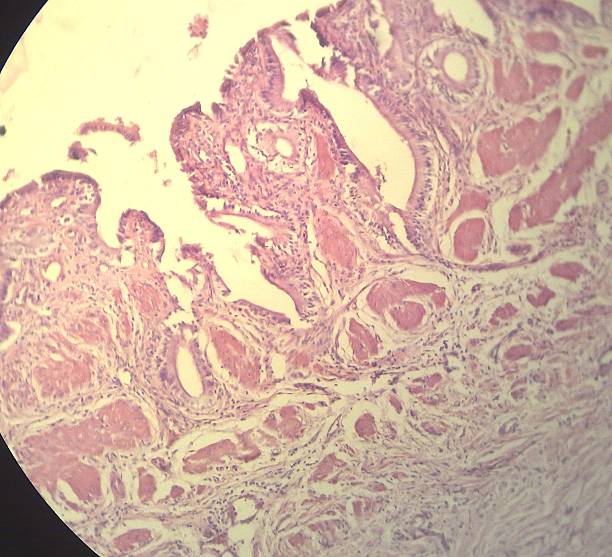 Chronic Cholecystitis ( H&E stain) Microscopic Pathology slide. The surface epithelium has lost its normal delicate papillary appearance with an increase in fibrous tissue and mild chronic inflammation in the lamina propria  lamina propria stock pictures, royalty-free photos & images