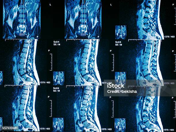 Mri Scan Of Human Spine Portion Stock Photo - Download Image Now - Data, Headache, Healthcare And Medicine