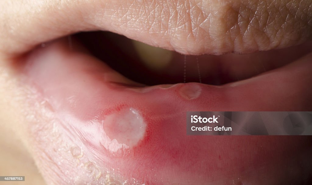 mouth dental ulcer medical symptom mouth dental ulcer canker sore Blister Stock Photo