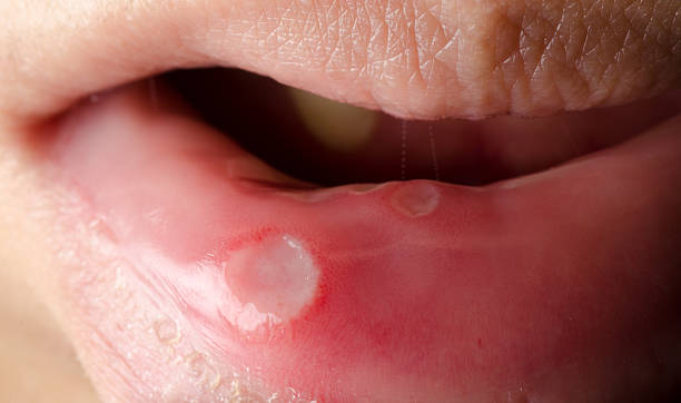 mouth dental ulcer stock photo