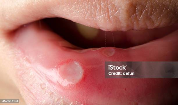 Mouth Dental Ulcer Stock Photo - Download Image Now - Blister, Illness, Adult