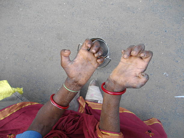 Leprosy patient begs for survival. Patna, India- October 30, 2013: Unidentified poor leprosy patient begs on street side. Such poor woman survives by begging on Patna street. leprosy stock pictures, royalty-free photos & images