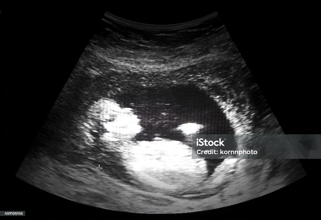 ultrasound film ultrasound film of thirteen week fetus Ultrasound Stock Photo