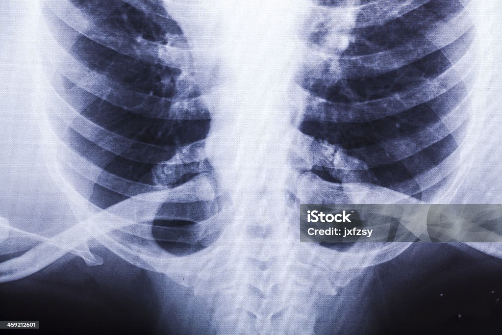 x-ray de la poitrine. - Photo de Anatomie libre de droits