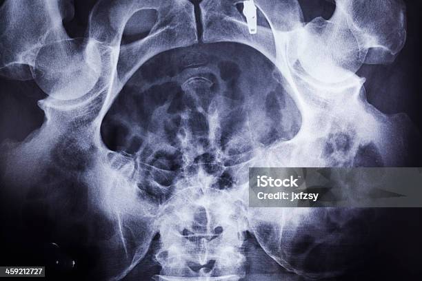 골반강 X 레이 X-레이에 대한 스톡 사진 및 기타 이미지 - X-레이, 개체 그룹, 건강 진단