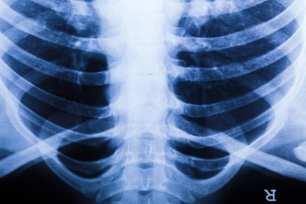istock x ray of chest 459212747