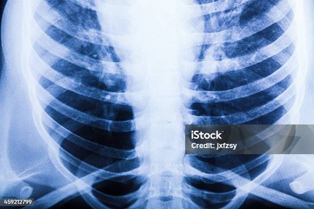 흉부 X 레이 X-레이에 대한 스톡 사진 및 기타 이미지 - X-레이, 건강 진단, 건강관리와 의술