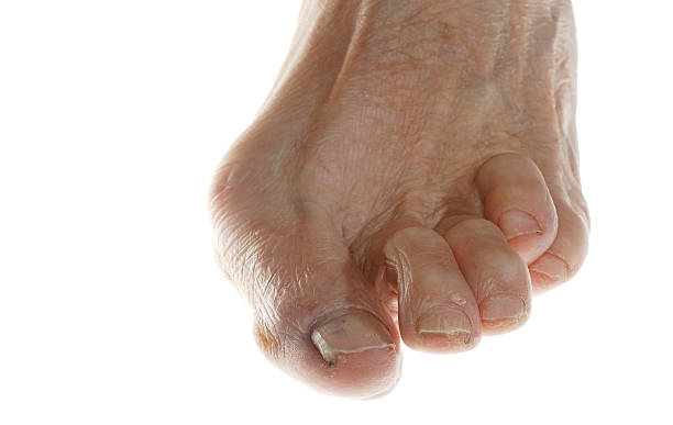 풋 버섯 - bunion bunions human foot podiatry 뉴스 사진 이미지