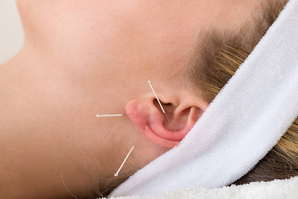 Primer plano de la acupuntura agujas sobre una oreja. - foto de stock