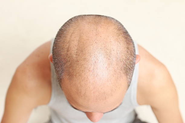 istock A man showing his head with thin hair 459892927