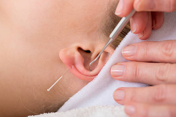 Homeópata tratamiento de mujer con la acupuntura. - foto de stock