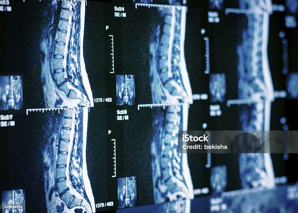 MRI Scan of human spine Human spine with Discus Hernia depicted on MRI transparency. Data Stock Photo