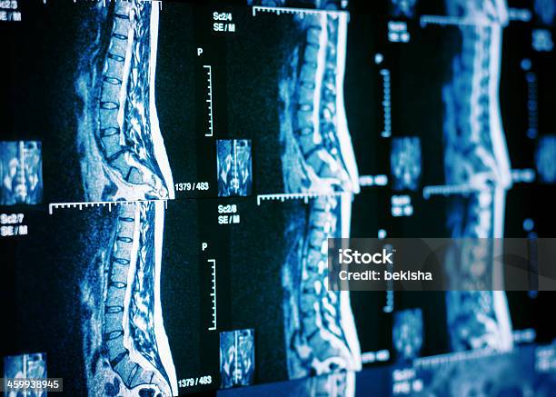 Mri Scan Of Human Spine Stock Photo - Download Image Now - Data, Headache, Healthcare And Medicine