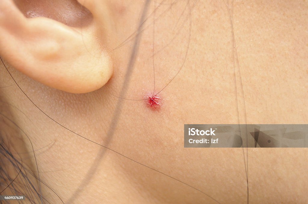 pimple on the face close-up pimple on the  face close-up Acne Stock Photo