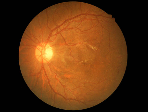 medical foto retinopatia diabetica neovascolarizzazione - nuerotic foto e immagini stock