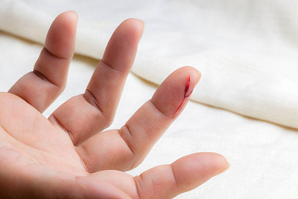 Injured finger Injured finger with bleeding open cut cut wound stock pictures, royalty-free photos & images