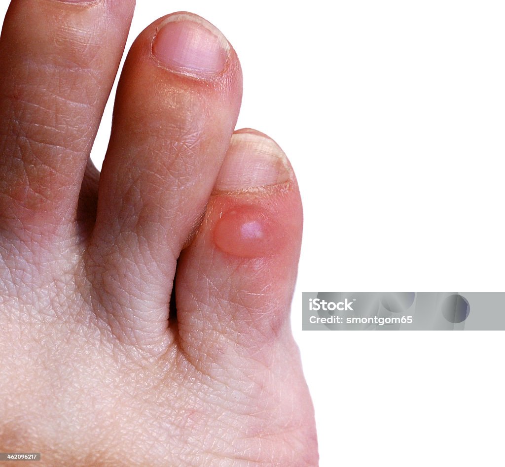 Blister on little toe Blister on little toe of right foot Blister Stock Photo