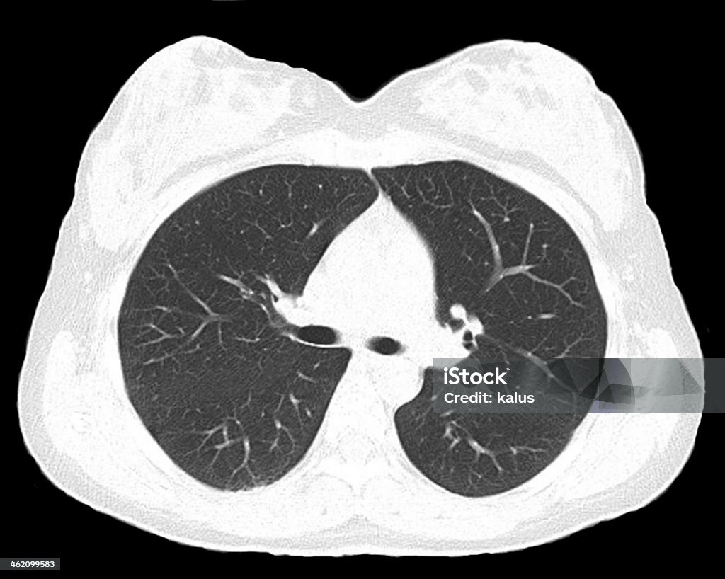 Pulmones - Foto de stock de Tomografía axial computerizada libre de derechos