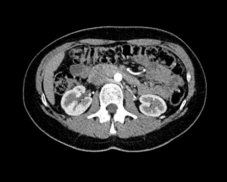 Normal kidneys on computed tomography scan