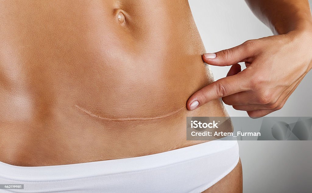 Scar of caesarean section Closeup of woman belly with a scar from a cesarean section Scar Stock Photo