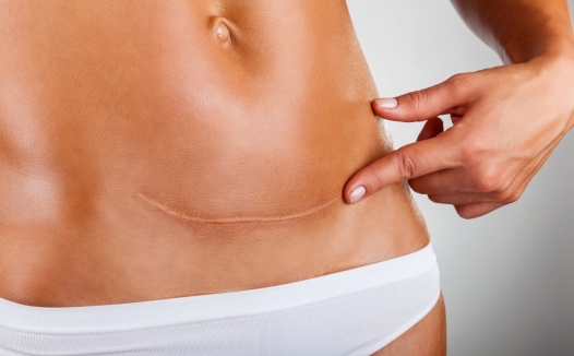 Scar Of Caesarean Section Stock Photo - Download Image Now - Scar,  Caesarean Section, Abdomen - iStock