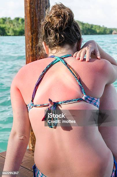 Sonnenbrand Sommer Haut Stockfoto und mehr Bilder von Sonnenbrand - Sonnenbrand, Bräunungsstreifen, Brennen