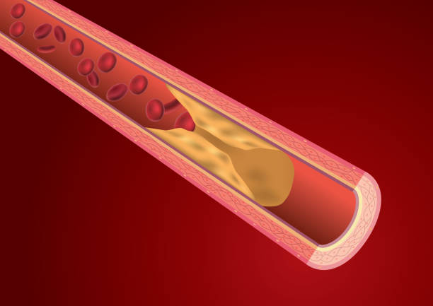 zablokowaniem naczynia krwionośnego - blood cell anemia cell structure red blood cell stock illustrations