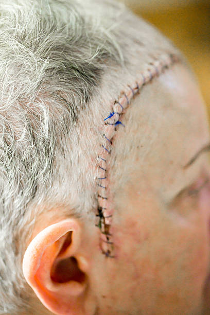 Medical Stitches And Incison After Brain Surgery Stock Photo - Download  Image Now - Medical Stitches, Stitching, Surgery - iStock