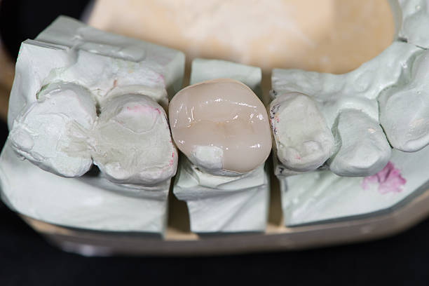 istock closeup for dental partial crown on a  plaster teeth model 462799755