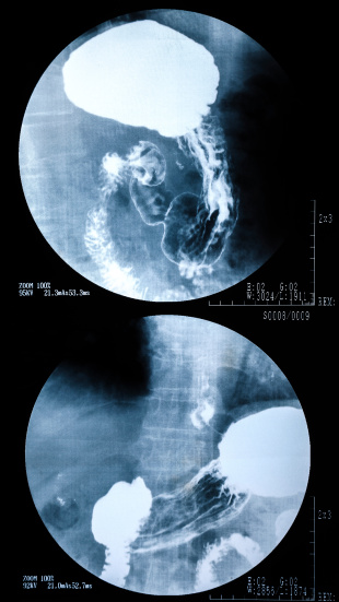 X-ray image of stomach