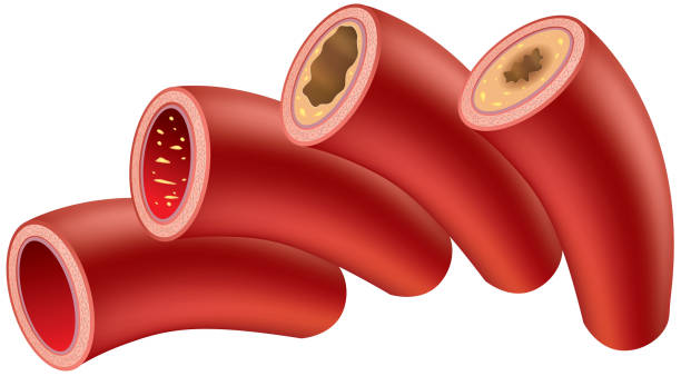 Atherosclerosis Gradient and transparent effect used. clogged artery stock illustrations