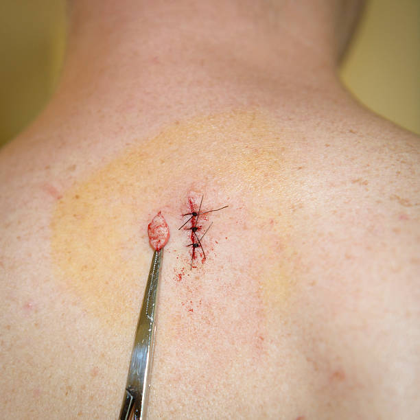 surgical removal of pre-cancerous tissue - basalcellscancer bildbanksfoton och bilder
