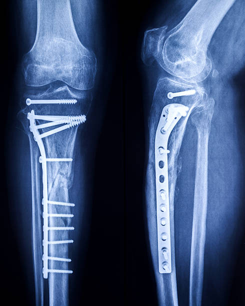 X-ray image of broken legs with osteosynthetic material X-ray image of broken legs with osteosynthetic material tibia photos stock pictures, royalty-free photos & images