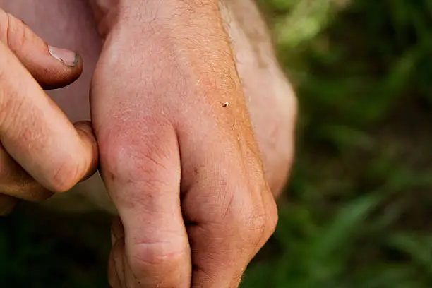 Photo of Bee sting on hand