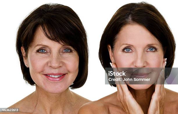 Before And After Stock Photo - Download Image Now - Before and After, Botulinum Toxin Injection, Human Face