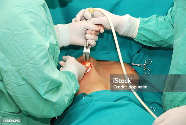 A Operação - Fotografias de stock e mais imagens de Implante mamário - Implante mamário, Cirurgia, Remover