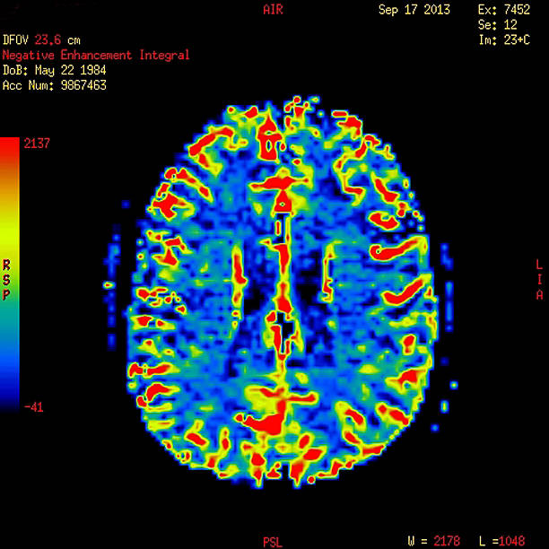 perfusion senhor de imagem normal de um cérebro - neuroscience mri scan brain brain surgery - fotografias e filmes do acervo