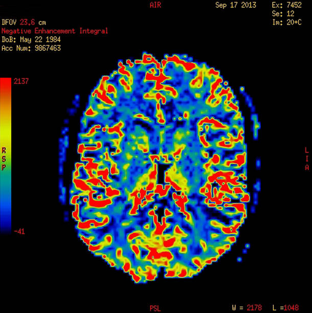 istock Perfusion MR imaging of a normal brain 464185873