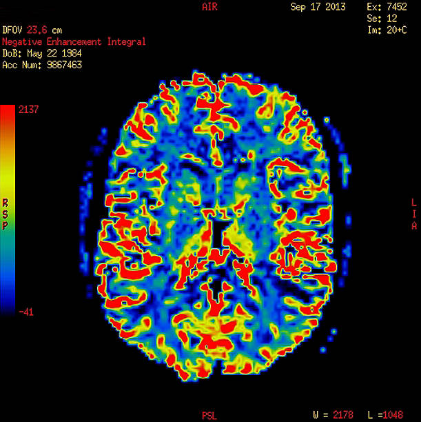 perfusion senhor de imagem normal de um cérebro - neuroscience mri scan brain brain surgery - fotografias e filmes do acervo