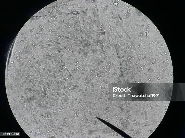 Cytology Smear Of Pleural Effusion Showing Candida Organ Stock Photo - Download Image Now