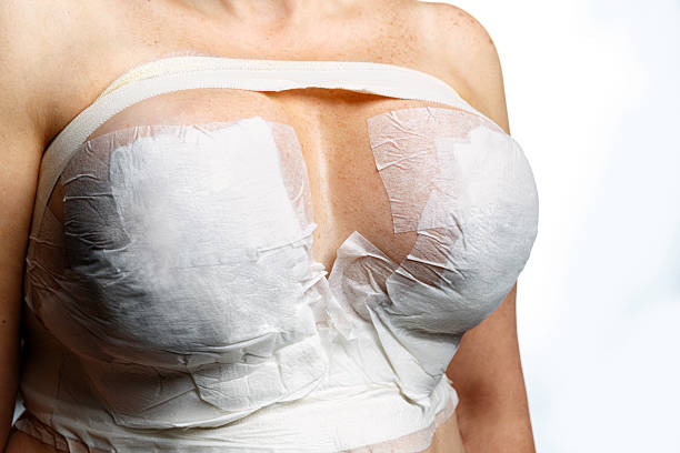 mujer con vendas después de la cirugía cosmética implante de mamas - covered nudity fotografías e imágenes de stock