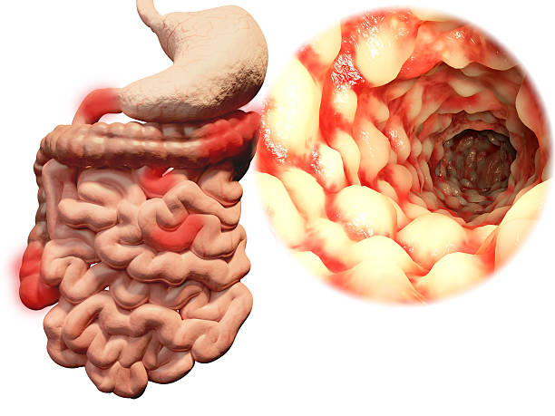 Crohn's disease Crohn's disease is an inflammatory bowel disease. It can affect any part of the gastrointestinal tract. The most common sites are highlighted in this image. human duodenum stock pictures, royalty-free photos & images