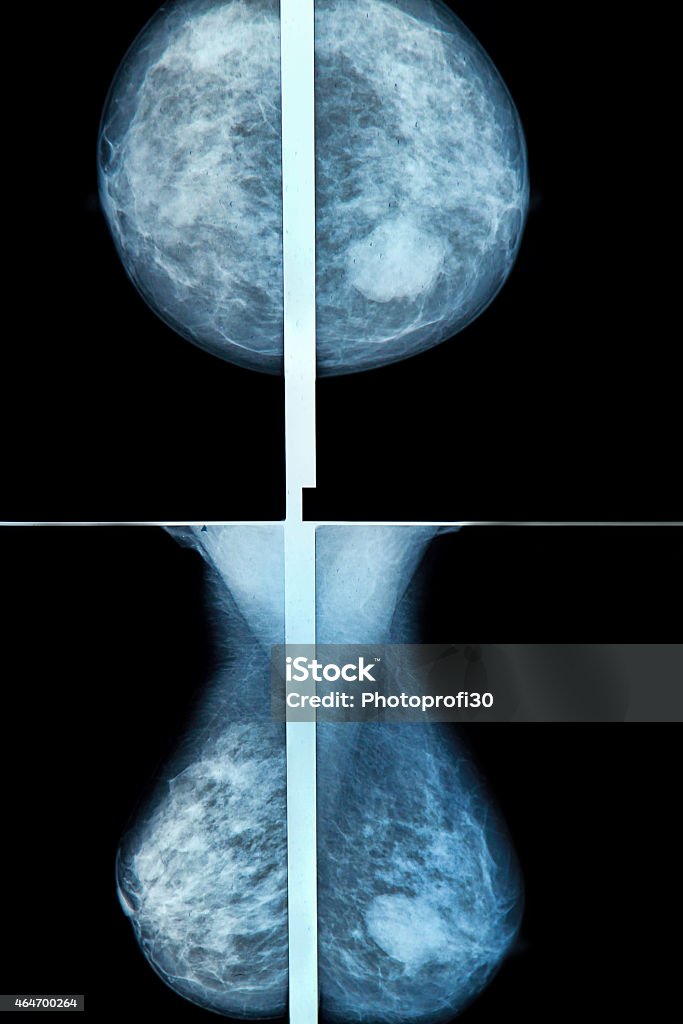 Mammography mammography breast scan X-ray image Mammogram Stock Photo