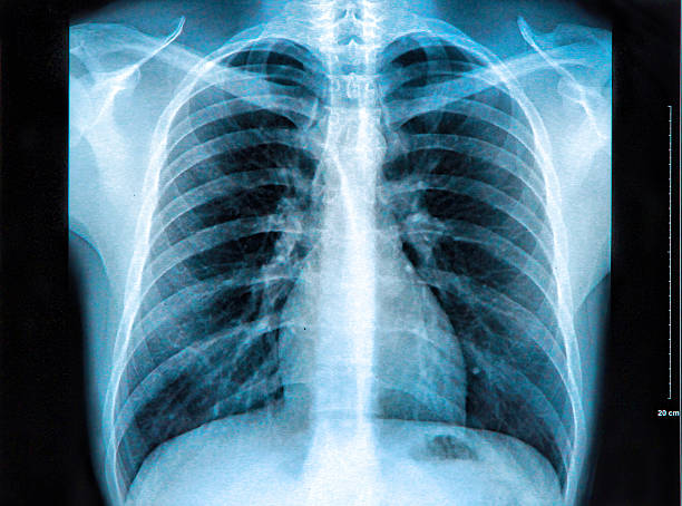 zdjęcie rentgenowskie klatki piersiowej - x ray chest human lung rib cage zdjęcia i obrazy z banku zdjęć