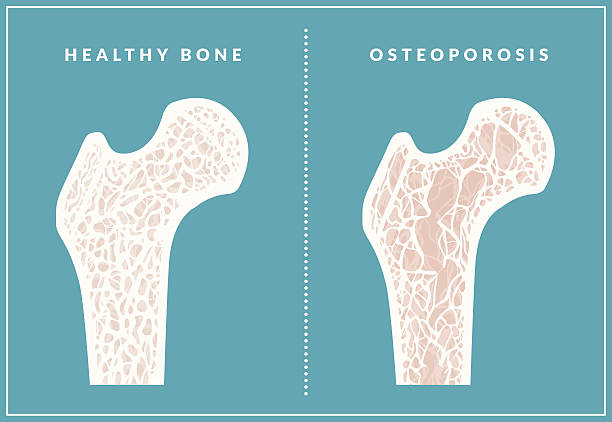 osteoporoza - kość stock illustrations