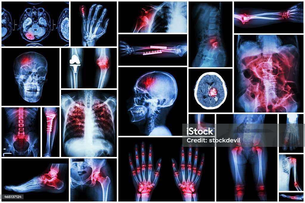 X-ray multiple disease X-ray multiple disease ( stroke (CVA) , fracture , shoulder dislocation , bowel obstruction , rheumatoid arthritis , gout , osteoarthritis knee , orthopedic surgery , pulmonary tuberculosis (TB), etc) Ankle Stock Photo